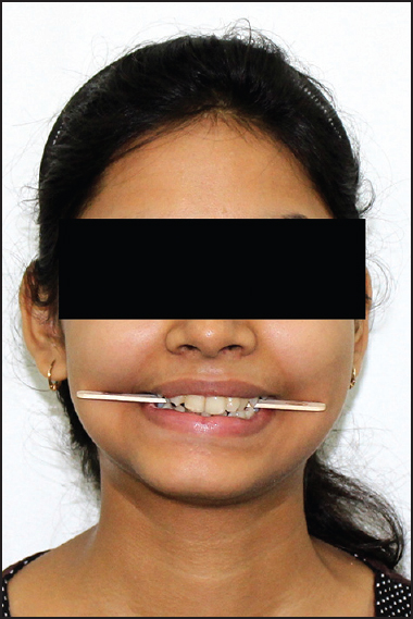 Figure 3: Evaluation of cant of occlusal plane