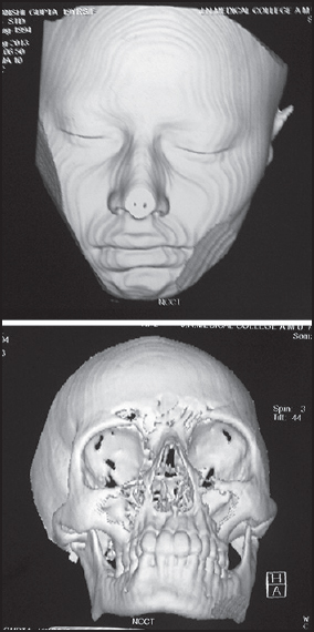 Figure 8: A Three-dimensional image of a case with Facial Asymmetry