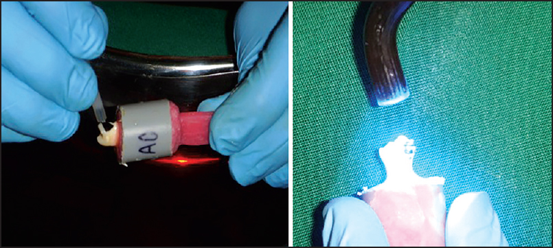 Figure 3: Application of antioxidizing agent and bonding of orthodontic brackets