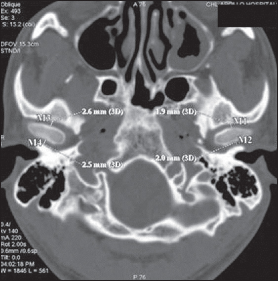 Figure 2: Computed tomographic scan of temporomandibular joint showing coronal section
