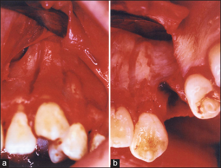 Figure 1: (a) Corticotomy applied to the canine (b) corticectomy applied to the extraction socket