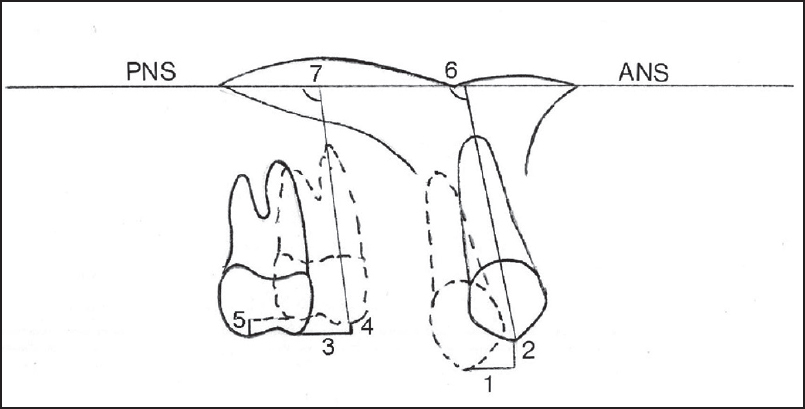 Figure 3: Linear and angular measurements on lateral cephalographs. (1) 3csag, (2) 3cver, (3) 6 mtsag, (4) 6 mtver, (5) 6dtver, (6) 3/PP, (7) 6/PP