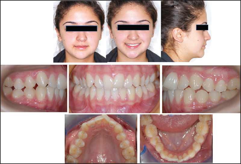 Figure 1: Pretreatment facial and intraoral photographs of the case