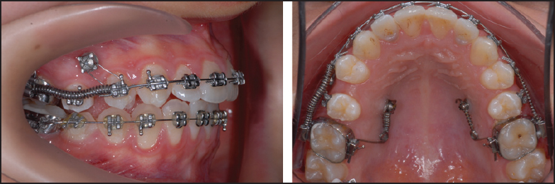 Figure 3: Intraoral buccal and occlusal views of the mechanics