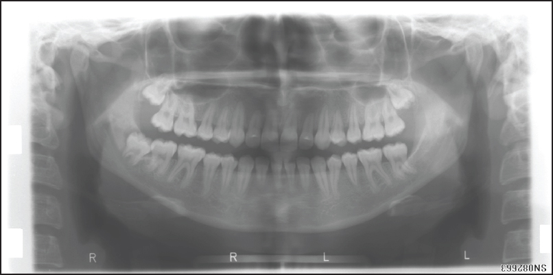 Figure 5: Posttreatment radiographic records of the case