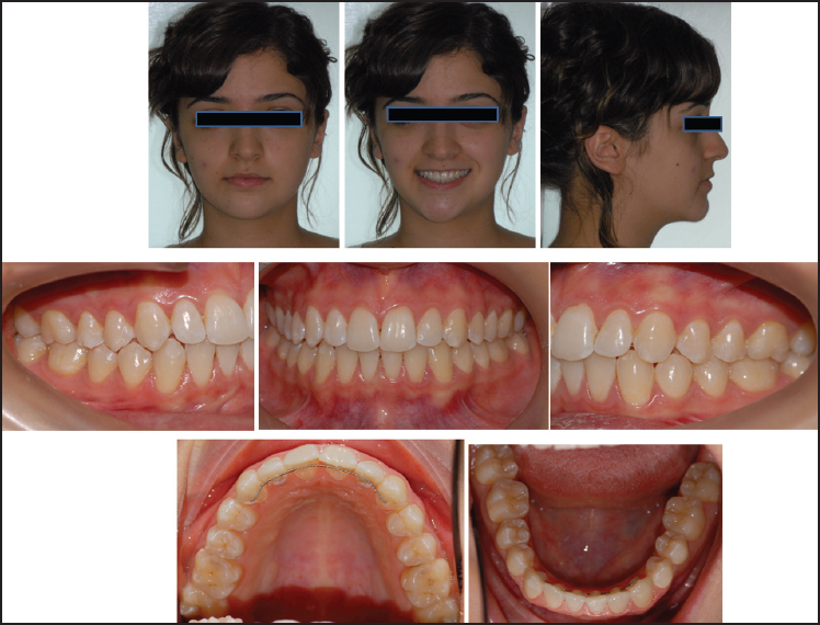 Figure 6: At the end of the 2 years, retention period facial and intraoral photographs of the case