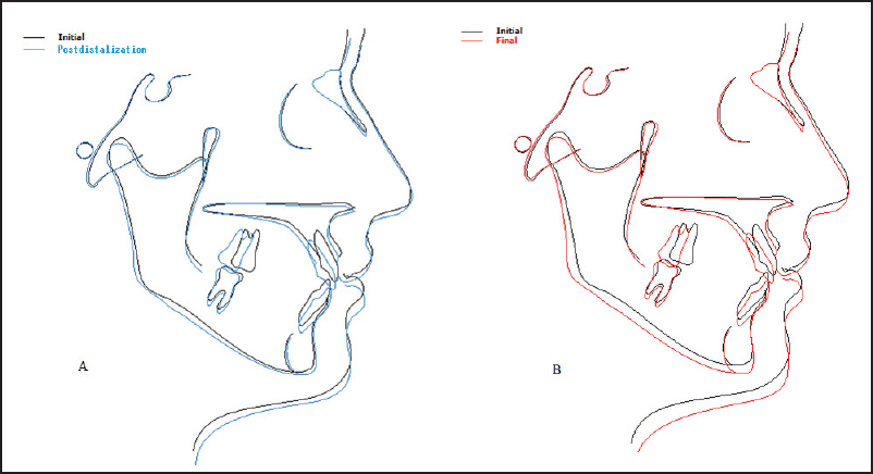 Figure 7: Superimpositions of (a) pretreatment and postdistalization cephalometric tracings and (b) pretreatment and posttreatment cephalometric tracings