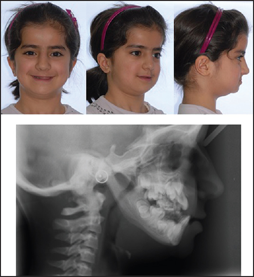 Figure 1: The patient's extraoral photographs and cephalometric radiograph