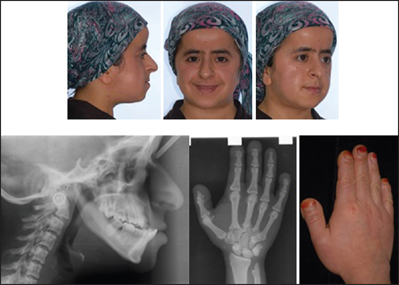 Figure 5: The aunt's extraoral, hand photos and cephalometric, handwrist films