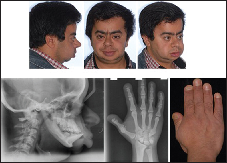 Figure 6: The uncle's extraoral, hand photos and cephalometric, hand-wrist films