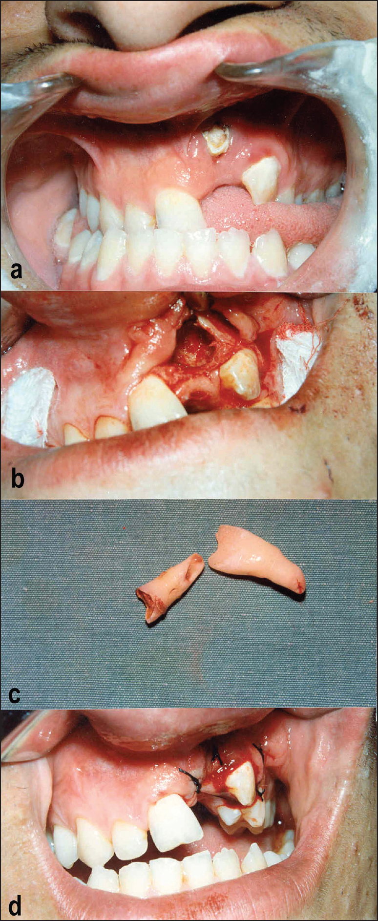 Figure 1: Photographs of the surgical procedure: (a) Upper left central and left lateral incisor teeth showing avulsion (unerupted). Anterior and posterior cross-bite with a loss of occlusal contact, except in the right upper first central incisor. (b-d) Surgical approach; impacted tooth roots and infected tissues were removed