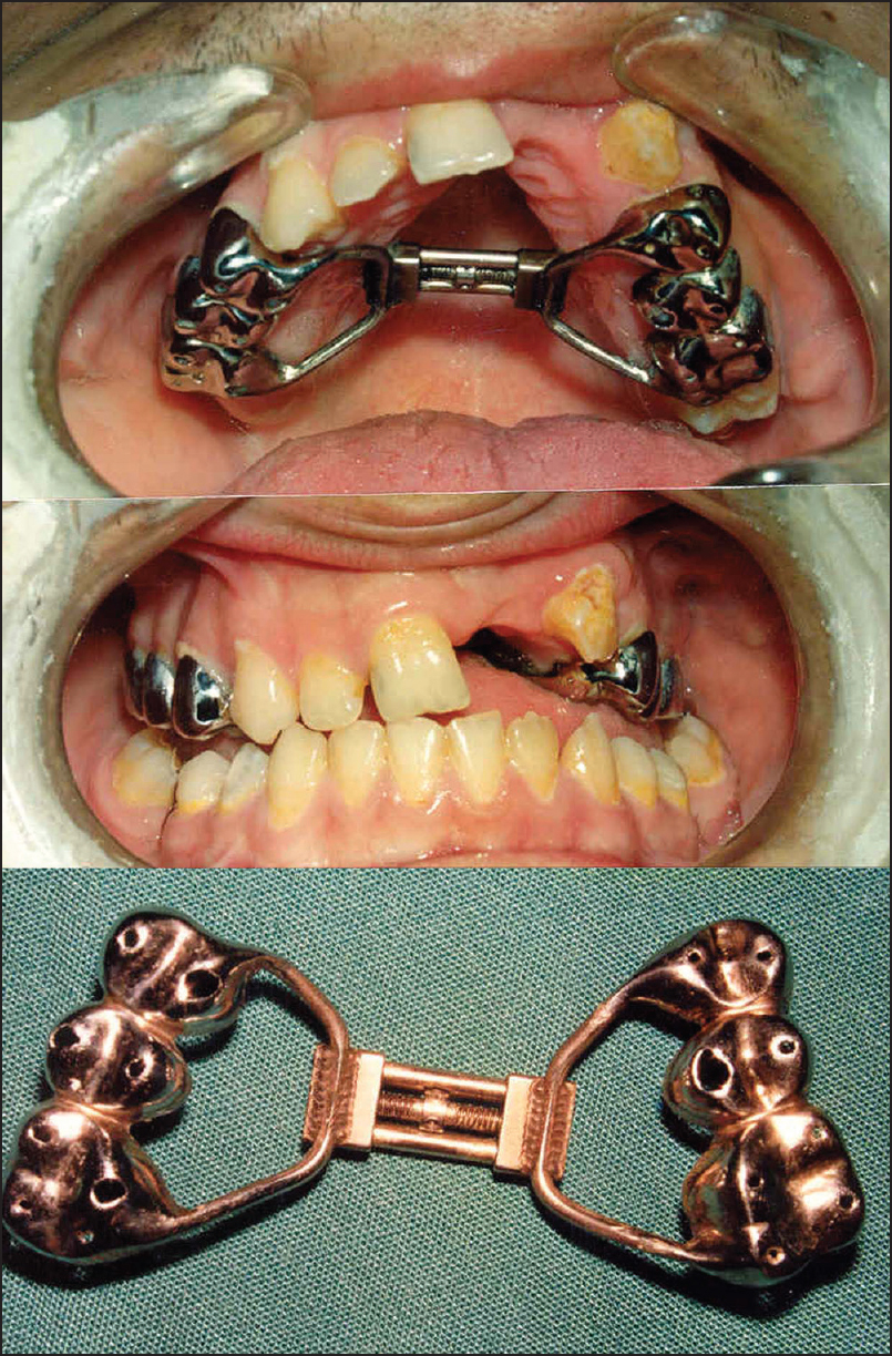 Figure 2: A fixed rapid maxillary expansion appliance with a Hyrax-type screw