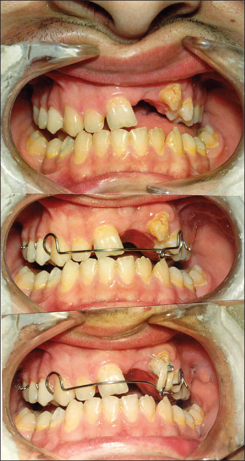 Figure 3: Removable orthodontic appliance for upper left canine tooth (for distal movement and extrusion)