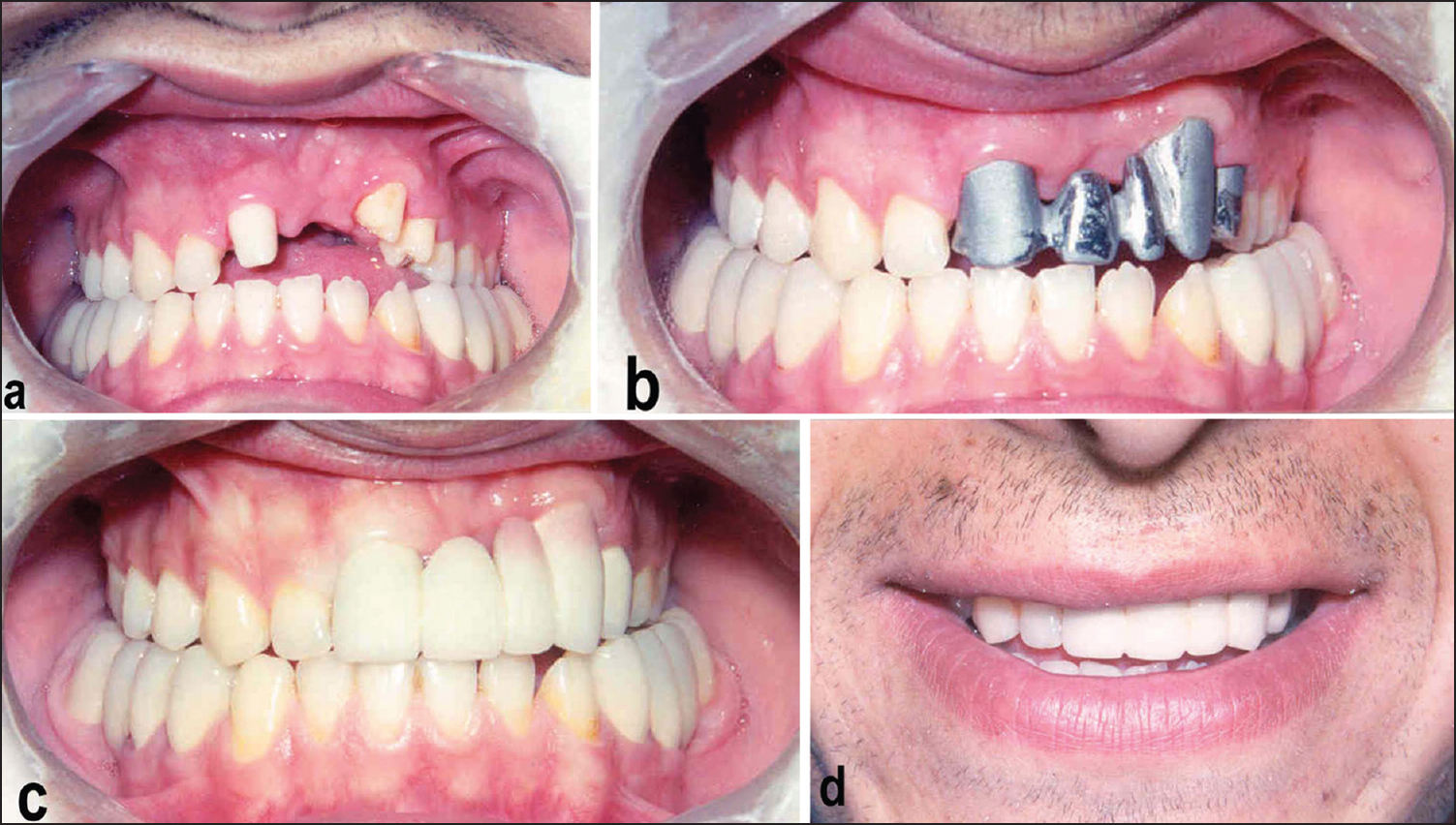 Figure 4: Anterior metal-porcelain bridge: (a) Prepared anterior teeth. (b) Checking the metal casting. (c) Anterior metal porcelain bridge. (d) Gained aesthetic appearance
