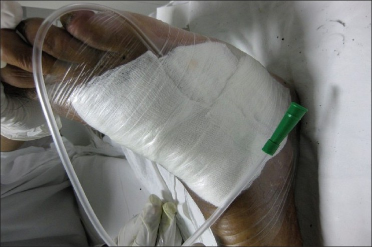 Figure 1: Showing application of negative pressure wound therapy