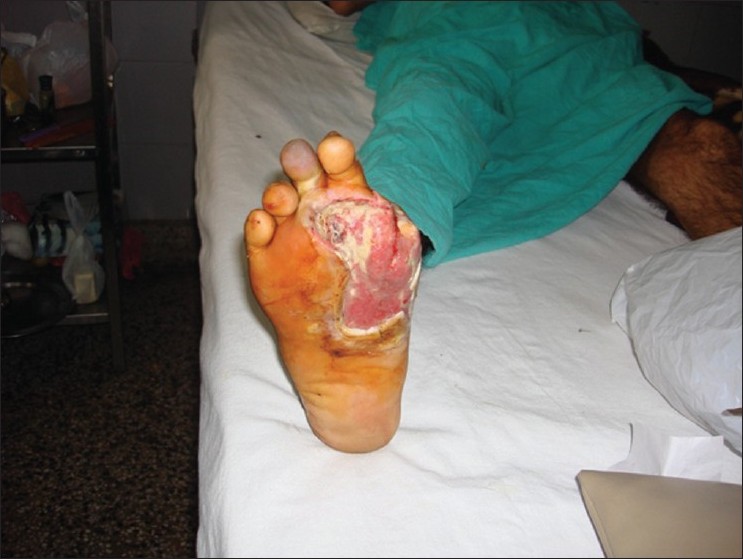 Figure 3: Diabetic ulcer treated with negative pressure wound therapy