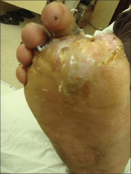 Figure 4: Postoperative picture of the healed ulcer