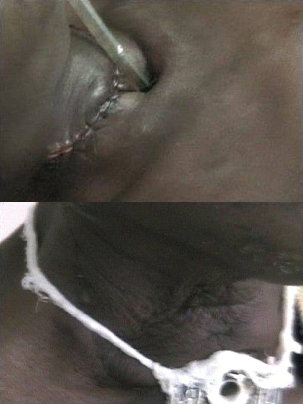 Figure 3: (a)Immediate Post operative wound after total laryngectomy with endotracheal tube at the tracheostomy
Figure 3b: No leakage after testing with oral milk drink on 9th postoperative day