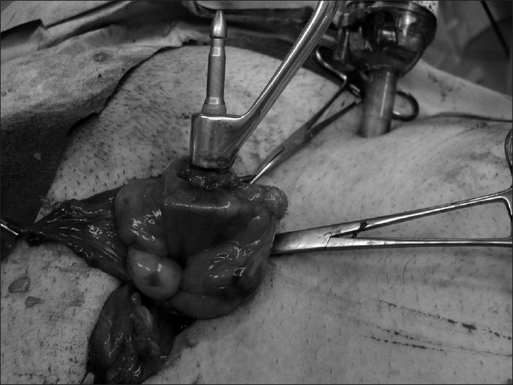Figure 2: The bowel resection was performed extracorporeally through the hernia sac, and an anvil was placed in the proximal end of the colon over a purse-string suture