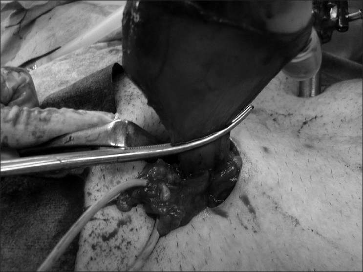 Figure 3: After the hernia sac was clamped with Kelly forceps, pneumoperitoneum was re-established