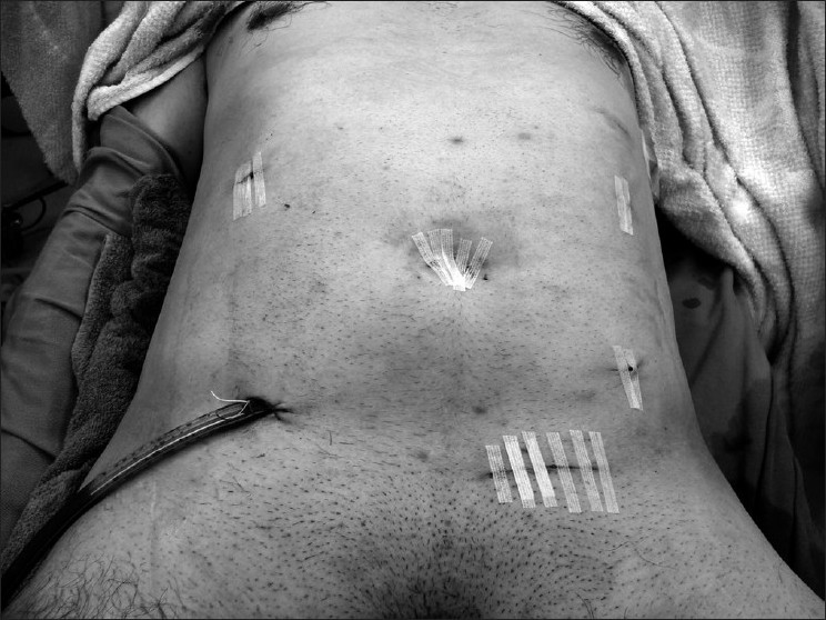 Figure 4: At the end of the operation, the patient had only a hernia repair wound and five trocar wounds