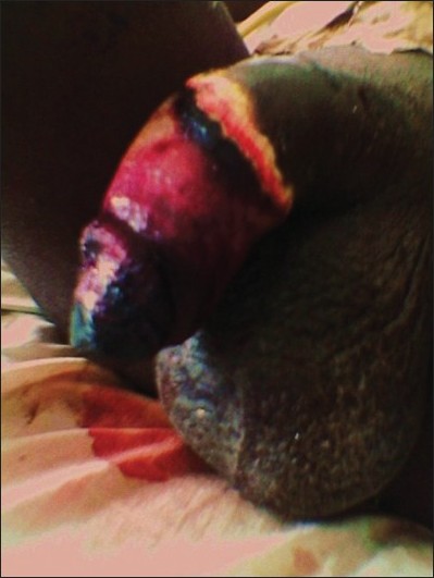 Figure 1: Wet gangrene that follows the initial ischemic changes