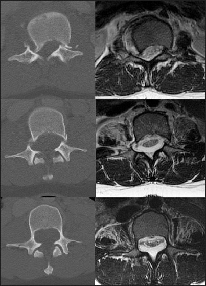 Figure 2: (Top) axial CT and T2 MRI at the level of L1 showing bilateral pedicle fractures and subluxation associated with canal compromise. (Middle) axial CT and T2 MRI at the level of L2 showing bilateral pedicle fractures and a dorsally located extradural meningeal cyst. (Bottom) axial CT and T2 MRI at the level of L3 showing aberrantly thin pedicles, anterior displacement of the neural elements, and dorsally located extradural meningeal cyst
