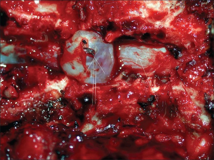 Figure 3: Intraoperative photo showing an extradural meningeal cyst (double arrow) dissected away from the dura of the thecal sac (single arrow)