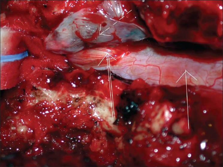 Figure 4: Intraoperative photo showing the emptied extradural meningeal cyst resected (broken arrow) and cyst ostium (double arrow) of the thecal sac (single arrow) laterally