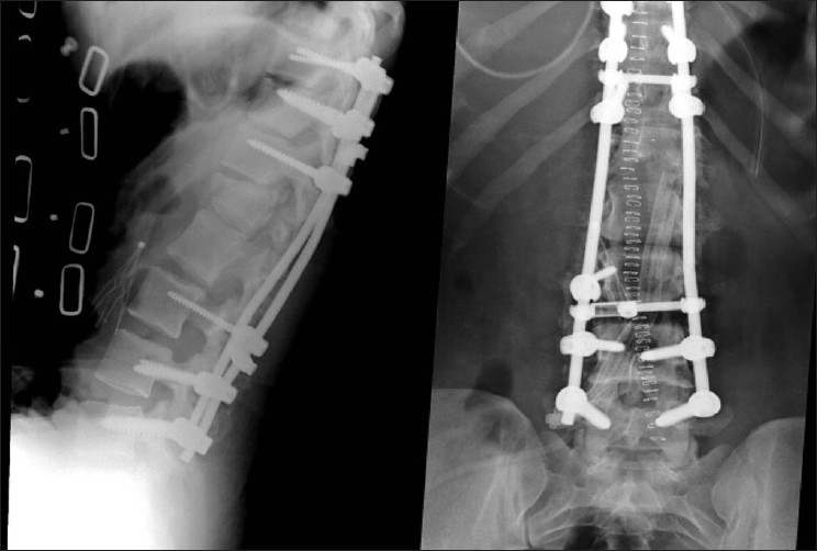 Figure 5: Postoperative AP and lateral X-rays showing good alignment, reduction of the subluxation, and instrumentation
