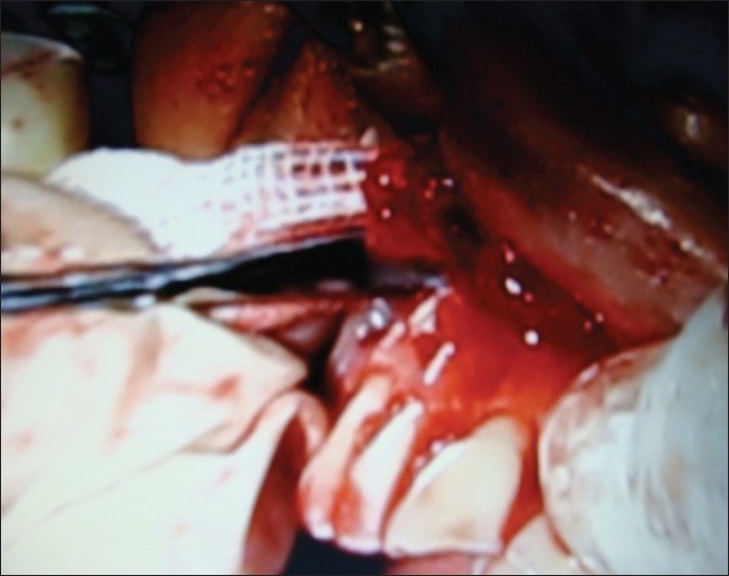 Figure 2: Sterilized gauze placed between the soft tissue mass and the lateral wall of the crypt from the distal aspect with the curette