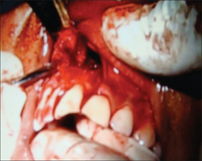 Figure 3: After separation of the periapical lesion from the surrounding bone and the nasal and palatal linings but attached to the root surface