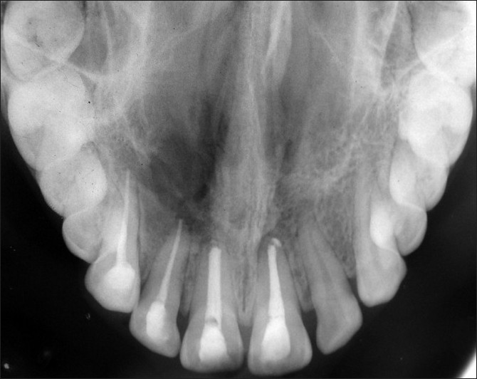 Figure 4: Radiograph at the 1½-year follow-up