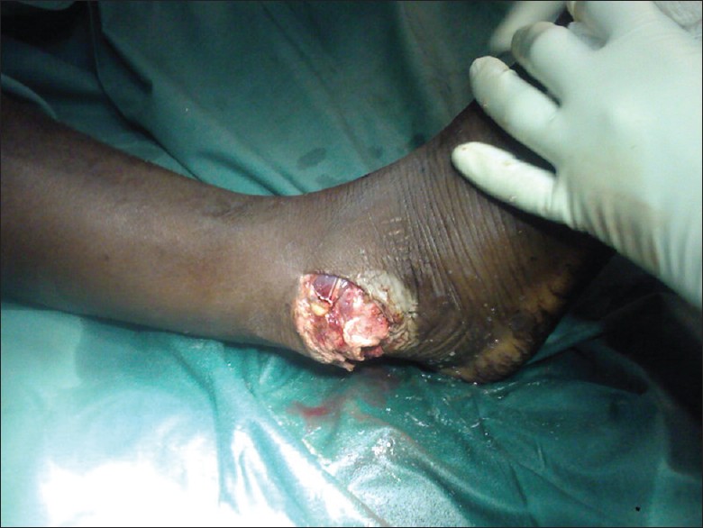 Figure 1: Right ankle injury showing wound on the lateral malleolus