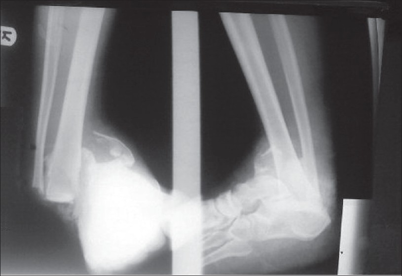 Figure 2: Radiograph of the right ankle with severe disruption of the ankle mortise