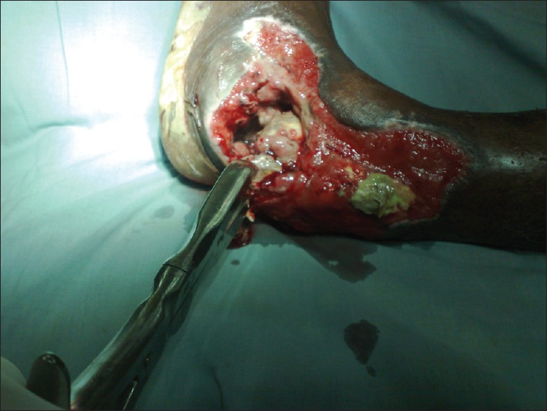 Figure 3: Infected open left ankle injury