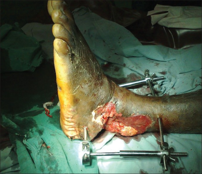Figure 4: Charnley's clamp after debridement