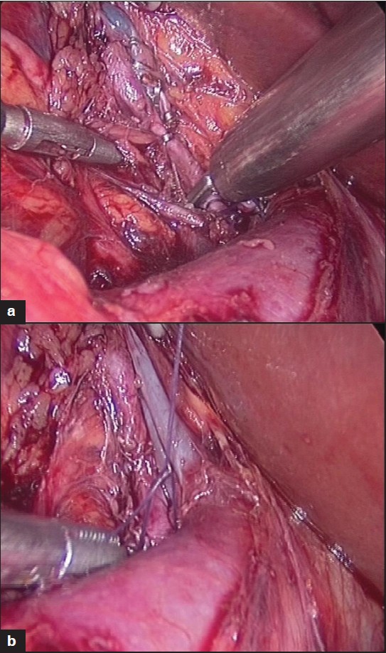 Figure 2: (a) Clipping of renal vein tributary, (b) Clipping of all right renal veins