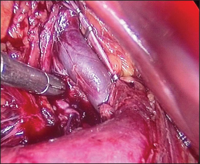 Figure 5: Clipping of all renal veins