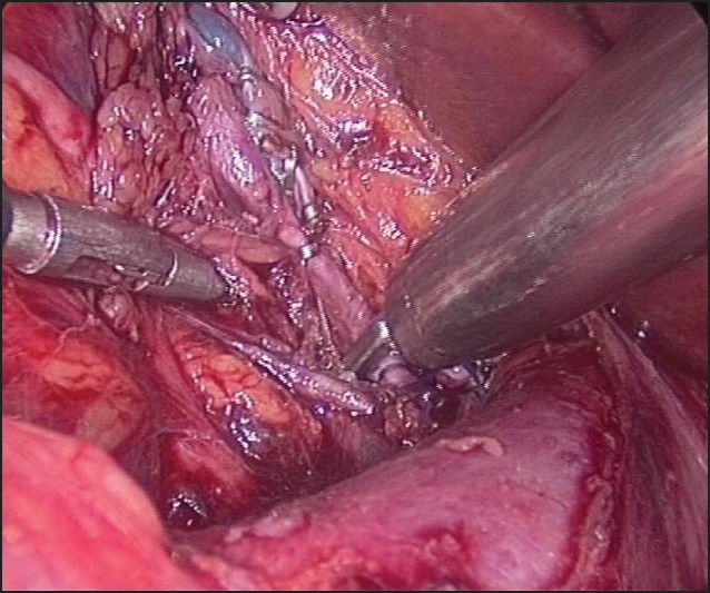 Figure 6: Clipping of renal artery