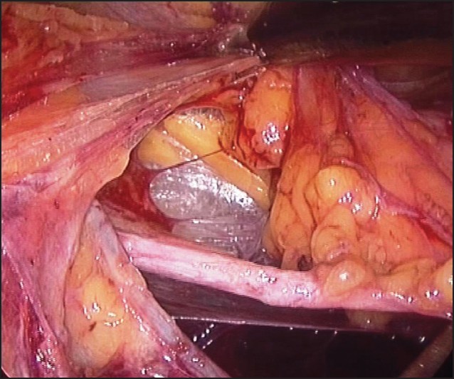 Figure 8: Dissection of ureter with lower pole