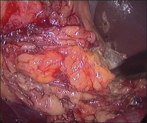 Figure 9: Dissection of upper pole near liver