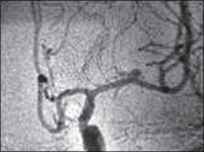 Figure 2: Cerebral angiogram showing left middle cerebral artery aneurysm (M-1 segment)