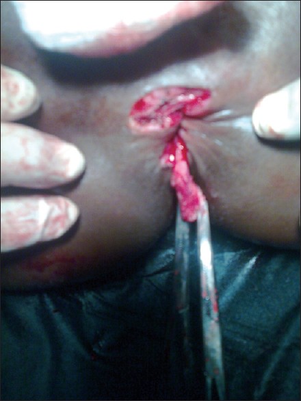 Figure 4: Dissected hemorrhoids prior to excision