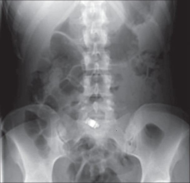 Figure 1: X-ray abdomen showing small bowel obstruction