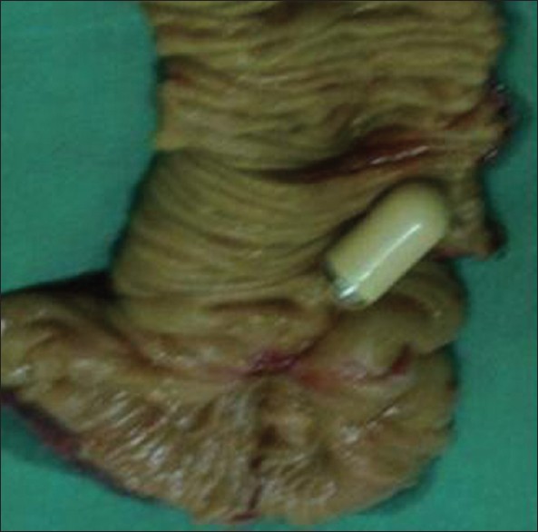 Figure 2: Resected specimen of small bowel with capsule endoscope