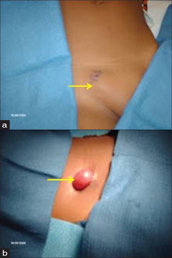 Figure 1: (a) Encysted hydrocele of canal of Nuck; (b) Operative finding– isolated cystic sac