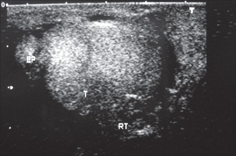Figure 2: Ultrasonogram of heterogeneous SOL of the right testis with multiple small nodules in the tunica vaginalis and vaginal hydrocele