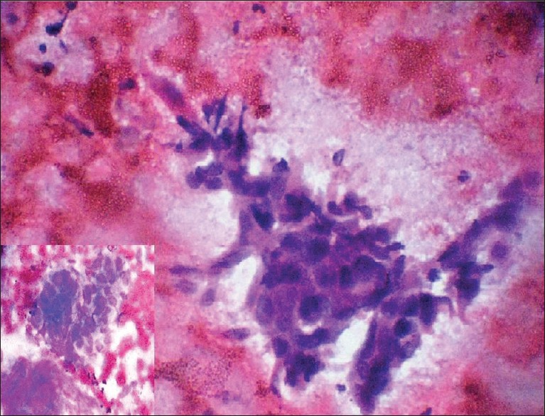 Figure 3: FNAC from hepatic SOL showing metastatic squamous cell carcinoma (Pap; × 400). Inset - FNAC from umbilical nodule showing metastatic deposits of squamous cell carcinoma (Leishman; × 400)