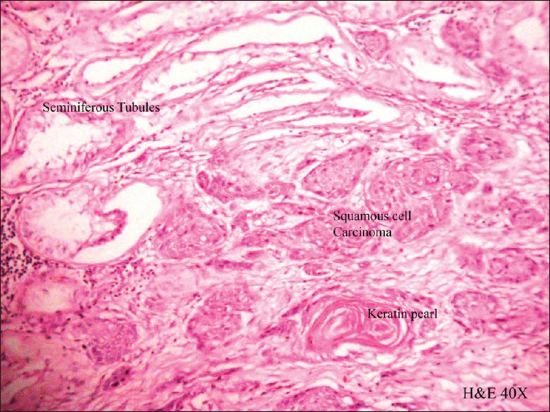 Figure 4: Well-differentiated squamous cell carcinoma invading the testicular tissue; the seminiferous tubules show gross suppression of spermatogenesis (H and E; × 100)